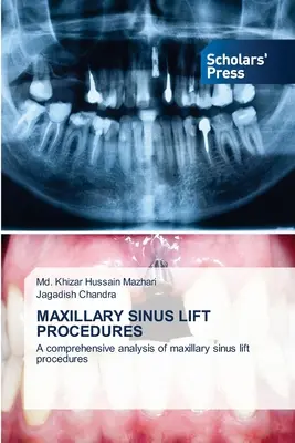 Procedimientos de elevación del seno maxilar - Maxillary Sinus Lift Procedures