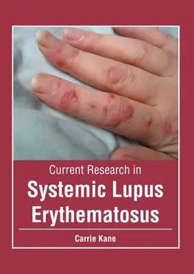 Investigación actual sobre el lupus eritematoso sistémico - Current Research in Systemic Lupus Erythematosus