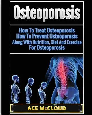 Osteoporosis: Cómo tratar la osteoporosis: Cómo prevenir la osteoporosis: Junto con la nutrición, la dieta y el ejercicio para la osteoporosis - Osteoporosis: How To Treat Osteoporosis: How To Prevent Osteoporosis: Along With Nutrition, Diet And Exercise For Osteoporosis