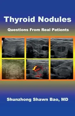 Nódulos tiroideos: Preguntas de Pacientes Reales - Thyroid Nodules: Questions From Real Patients