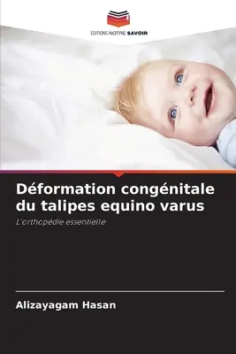 Dformation congnitale du talipes equino varus