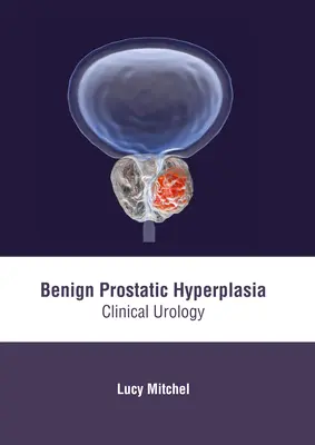 Hiperplasia prostática benigna: Urología clínica - Benign Prostatic Hyperplasia: Clinical Urology