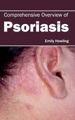 Panorama general de la psoriasis - Comprehensive Overview of Psoriasis