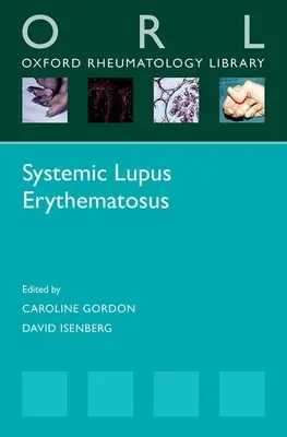 Lupus eritematoso sistémico - Systemic Lupus Erythematosus