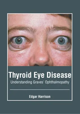 Enfermedad ocular tiroidea: Entender la oftalmopatía de Graves - Thyroid Eye Disease: Understanding Graves' Ophthalmopathy