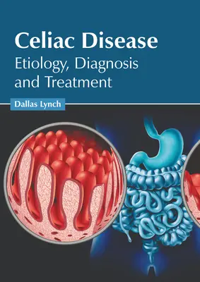 Enfermedad celíaca: Etiología, diagnóstico y tratamiento - Celiac Disease: Etiology, Diagnosis and Treatment