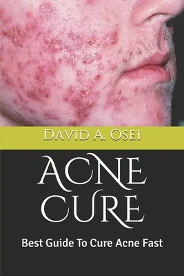 Cura El Acné: La Mejor Guía Para Curar El Acné Rápido - Acne Cure: Best Guide To Cure Acne Fast