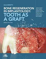 Regeneración ósea en implantología: el diente como injerto - Bone regeneration in implantology - tooth as a graft