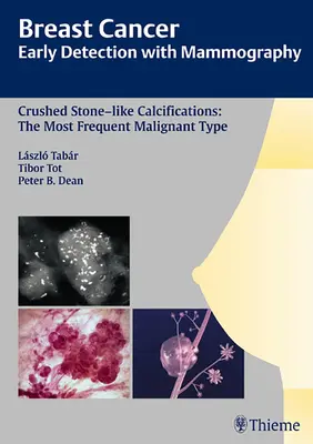 Cáncer de mama: Detección precoz con mamografía: Calcificaciones Similares a Piedras Aplastadas: El tipo maligno más frecuente [Con CDROM] - Breast Cancer: Early Detection with Mammography: Crushed Stone-Like Calcifications: The Most Frequent Malignant Type [With CDROM]