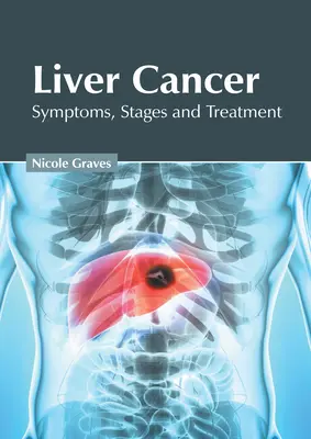 Cáncer de hígado: Síntomas, etapas y tratamiento - Liver Cancer: Symptoms, Stages and Treatment