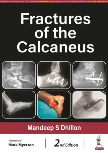 Fracturas del calcáneo - Fractures of the Calcaneus