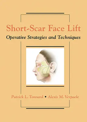 Estiramiento facial con cicatriz corta: Estrategias y técnicas operatorias - Short-Scar Face Lift: Operative Strategies and Techniques